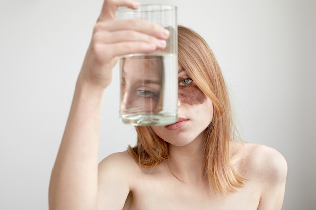 Woman with melasma holding glass of water