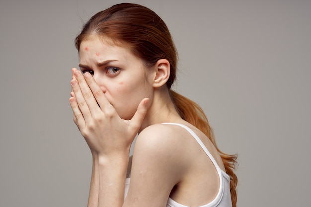 Woman with pimple on her face touching face with hands health\
problems acne