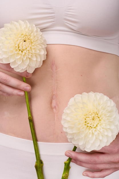 Woman with scar on body holding flowers