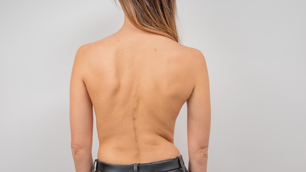 Donna con scoliosi della colonna vertebrale. schiena curva della donna con la pelle dell'acne.