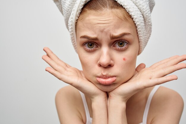 Woman with a towel on her head on a light background and\
pimples on her face transitional age clean