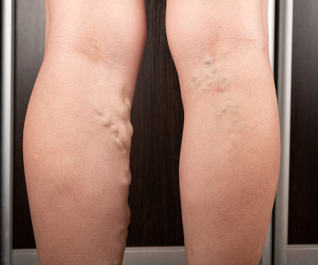 Woman with varicose legs thrombosis of distended veins