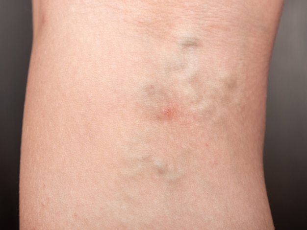 Woman with varicose legs, thrombosis of distended veins.