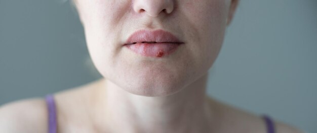 Photo the woman with a virus herpes on lips.