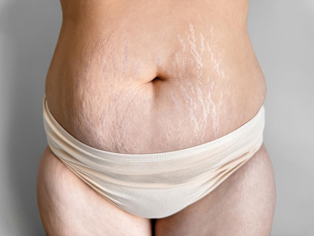 womans midsection with stretch marks to celebrate real beauty body positivity and the natural