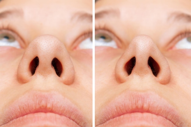 Womans nose before and after rhinoplasty The result of cosmetic plastic surgery on the nose