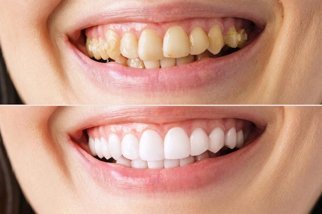 A womans smile in closeup before and after the bleaching procedure at the dentist