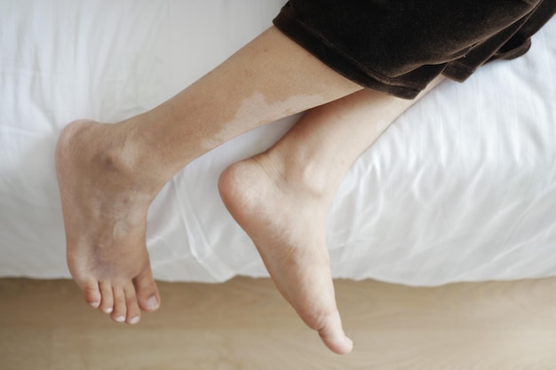 Women feet with vitiligo skin condition