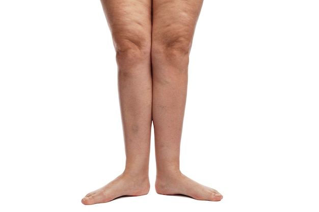 Women's legs with cellulite, veins and excess weight.