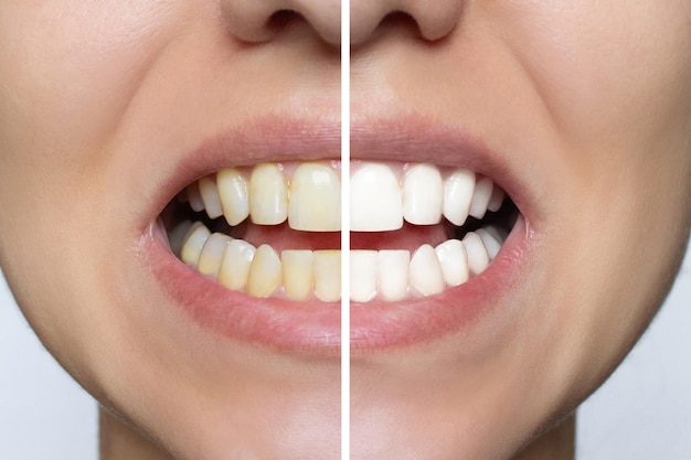 Женское отбеливание зубов вблизи до и после процедуры Верхняя и нижняя челюсть Стоматологическая клиника