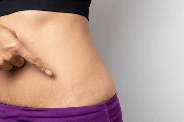 Women Show off the belly after birth Stretch Marks on white background