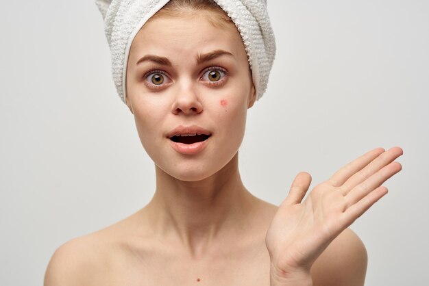 Women in a towel and with pimples on their face gesturing with\
their hands clean skin acne