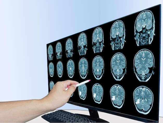 World Stroke Day CT Scan Brain A man suffering from pulsating pain of headache