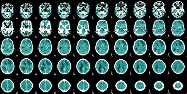 World Stroke DayCT Scan Brain Een man die lijdt aan pulserende pijn van hoofdpijn