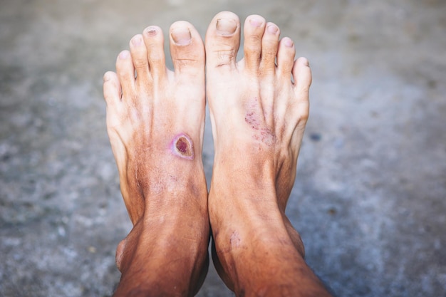 wound of beginning diabetic foot compare with normal foot Selected focus