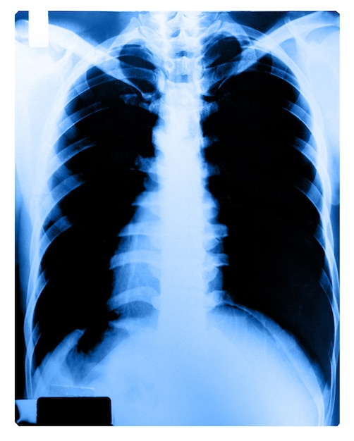 X-ray afbeelding van menselijke borst