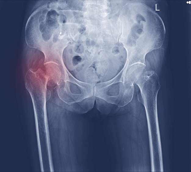 Photo x-ray both hip fracture neck femoral.