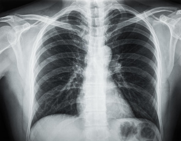 X-Ray of the Chest