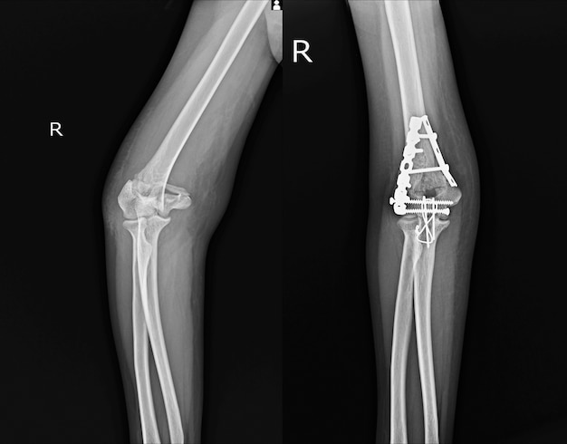 사진 상완골의 x 선 팔꿈치 케이스 골절.
