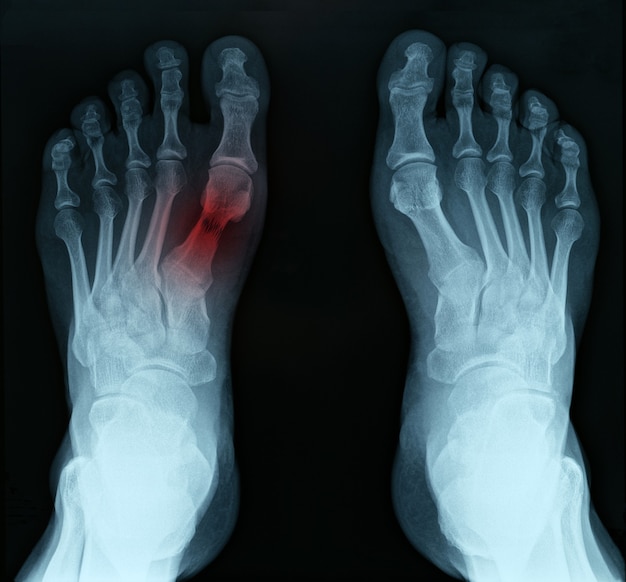 Photo x ray of feet with tarsal fracture closeup