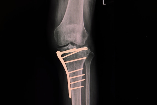 プレートとネジを固定した後の近位脛骨骨折患者の膝のx線フィルム