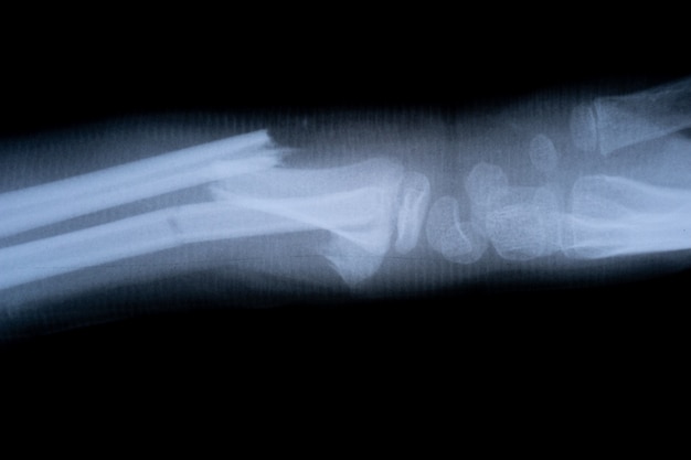 X-ray film skelet menselijke arm. gezondheid medische anatomie lichaamsconcept