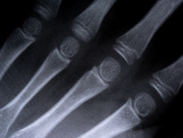 X-ray film skelet menselijke arm. gezondheid medische anatomie lichaamsconcept