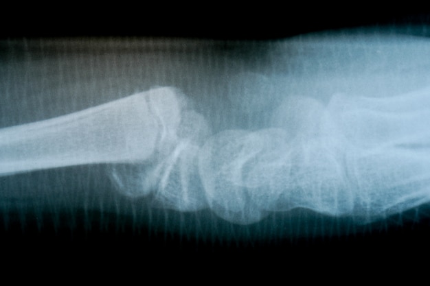 X-ray film skelet menselijke arm. gezondheid medische anatomie lichaamsconcept