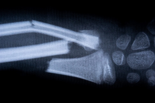 Foto braccio umano scheletro di pellicola a raggi x. concetto di corpo di anatomia medica sanitaria