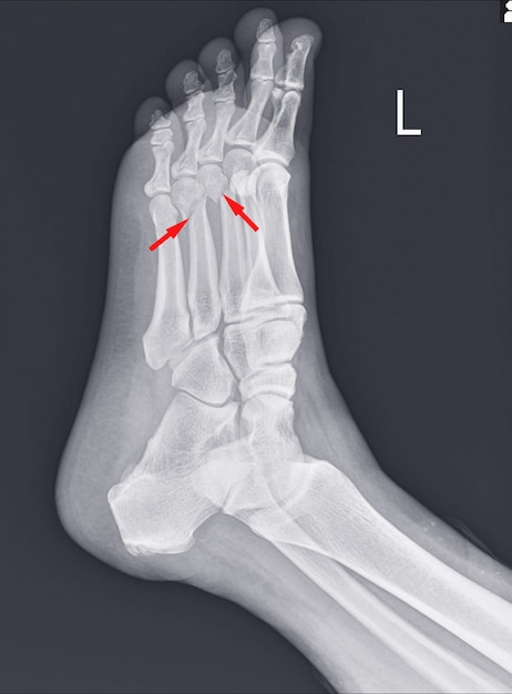 X-ray foot and ankle showing Metatarsal fractures .