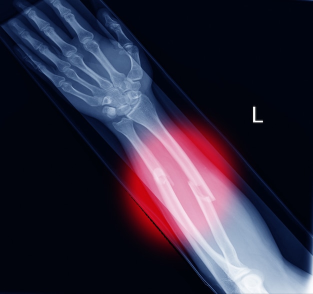 X-ray forearm (ap) view finding fracture