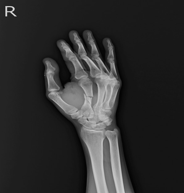 X-ray Hand AP, OBLIQUE: breuk middenschacht Rt.2nd. metacapal botweefsel zwelling.