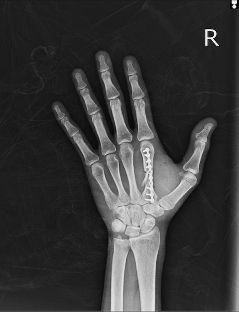 X-ray Hand AP, OBLIQUE: Fixatiefractuur tweede metacarpolbot met plaat en schroeven.