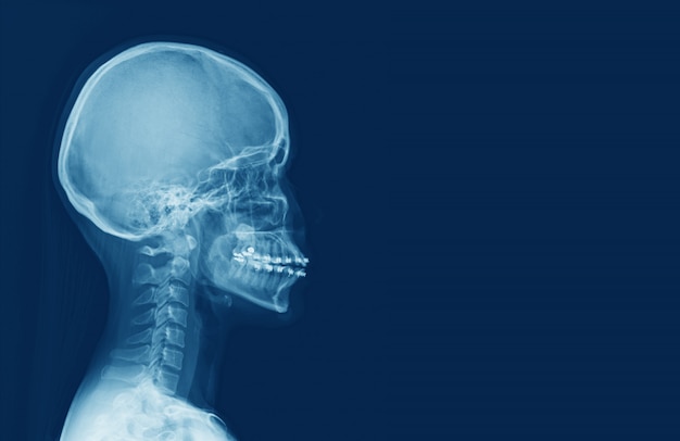 X-ray of human cervical spine and  head skull. sella turcica looks normal. Medical image concept.