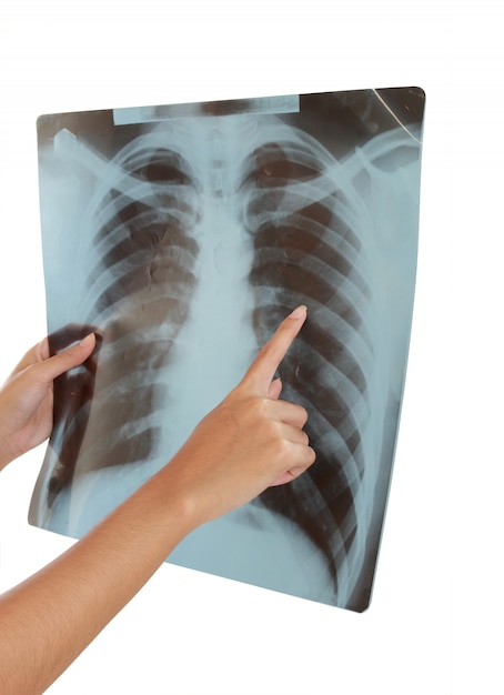 Рентгенография грудной клетки человека.