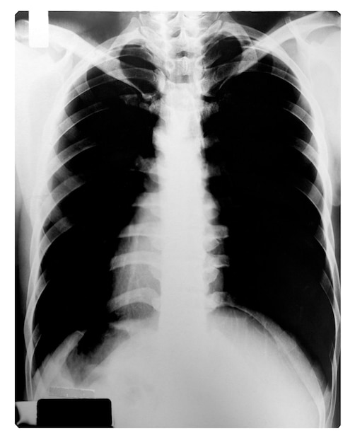 인간의 가슴의 X 선 이미지