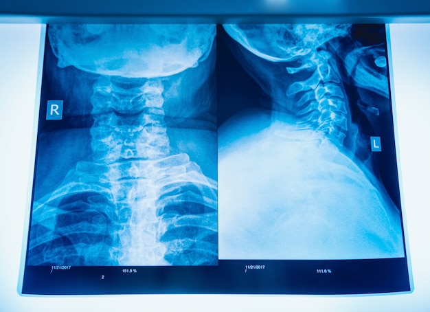 Photo x-ray image of human neck for a medical diagnosis.