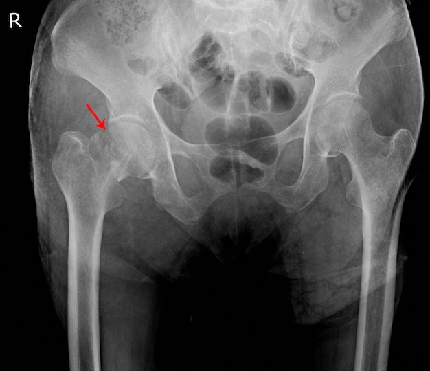 Photo x-ray image of painful hip in woman present fracture right hip joint