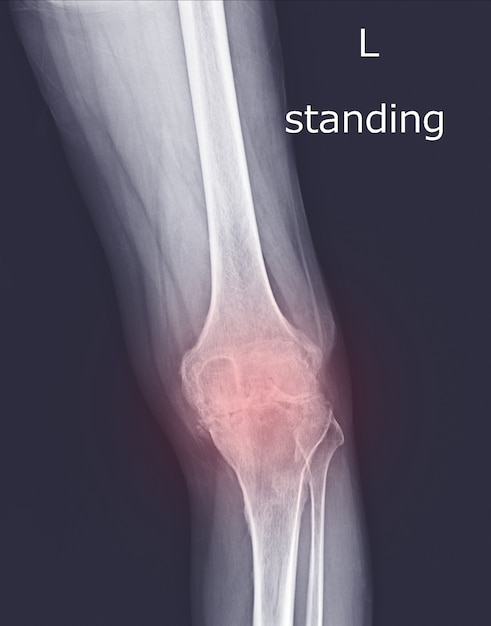 X-ray Kniegewricht (staande weergave) Degeneratine verandering van linkerknie op rode markering vinden.