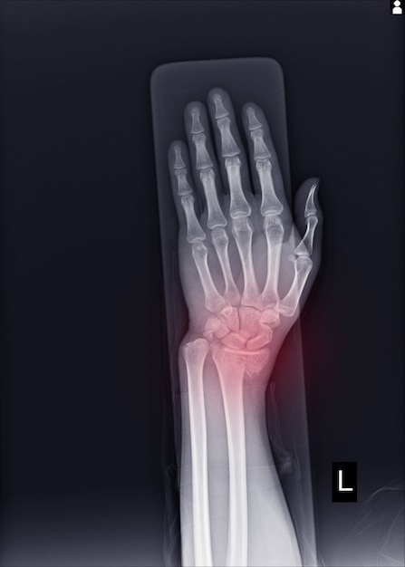 X-ray Left wrist joint Fracture with displacement distal end left radius.