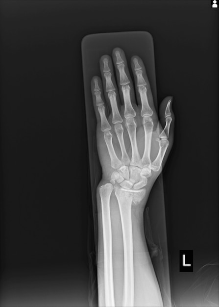 X-ray Left wrist joint Fracture with displacement distal end left radius.