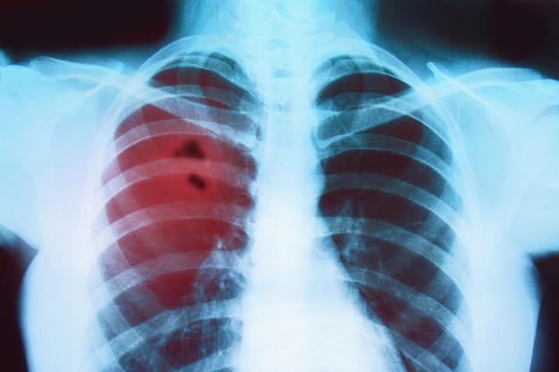 X-ray of the lungs of a sick person