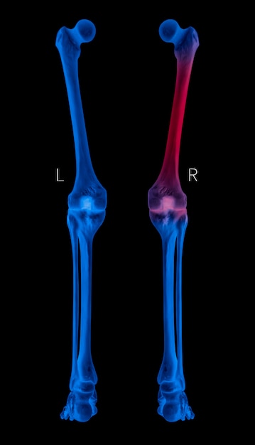 X-ray menselijk beenderen posterior overzicht met rode hoogtepunten in de pijngebieden van het dijbeenbeen, Blauwtintkleur