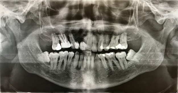 X-ray photo of human teeth