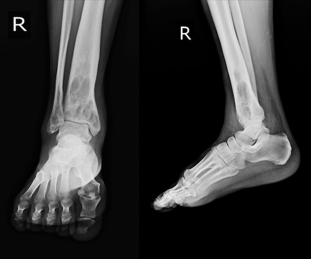 右遠位脛骨の骨髄内骨溶解性病変を発見したX線Rt.Ankle