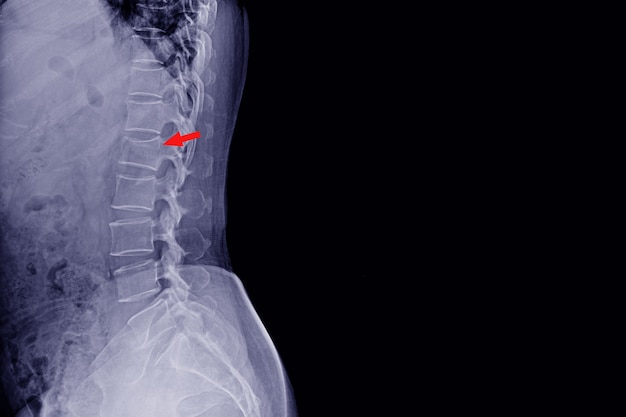 X-ray 척추 측방은 남성의 사고와 압박 골절 신체 척추 L1을 보여주는 blackpain의 역사를 보여줍니다. 정상적인 디스크 공간 및 척추 주위 연조직 의료 개념.