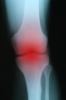 Raggi x con infiammazione rossa del primo piano dell'articolazione del ginocchio