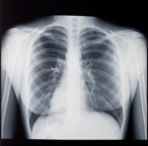 Photo x-ray of the woman's lungs, front view.