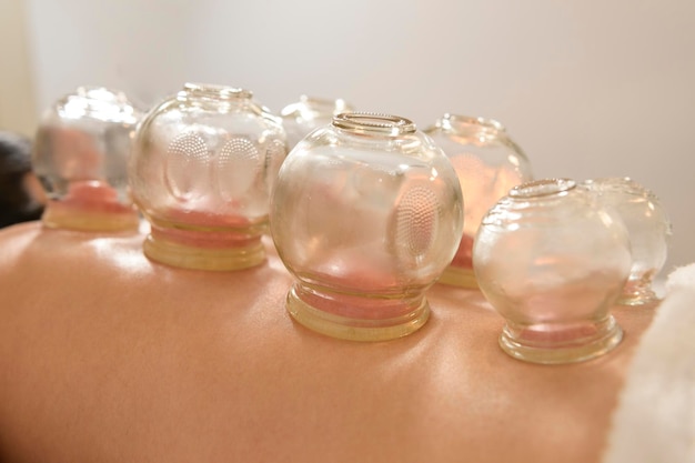 Xabeautiful woman received cupping treatment on back by\
therapist chinese medicine
