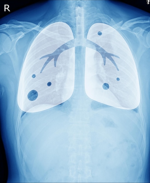 XRay-beeld van menselijke gezonde borst ziet er normaal uit Medisch beeldconcept